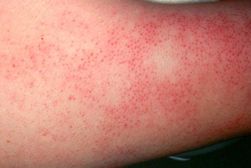 keratosis pilaris