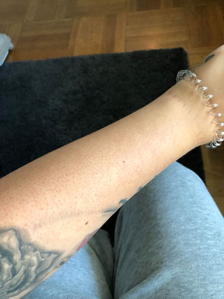 keratosis pilaris